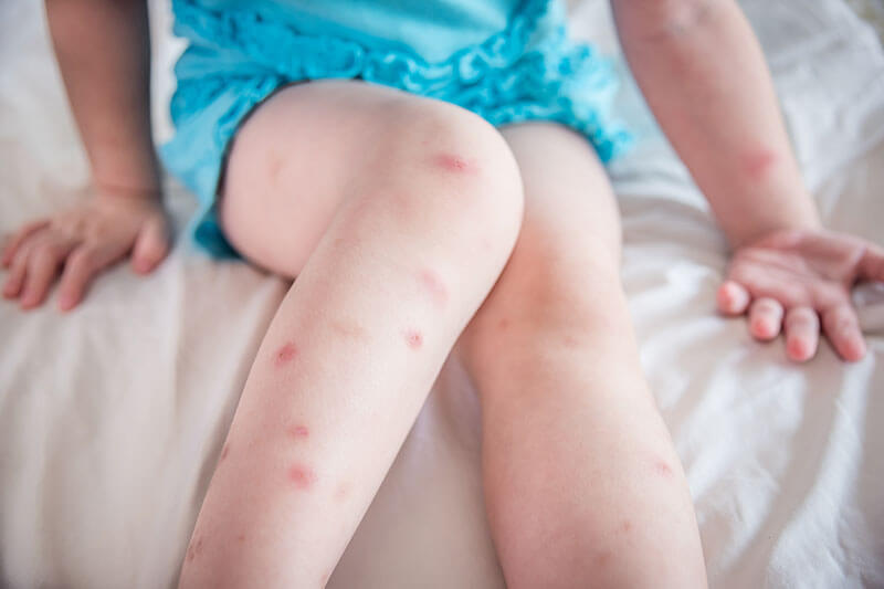 Bed bug bites on child's legs
